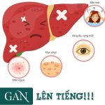 Định lượng GGT | 50 U/L