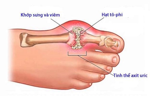 Xét nghiệm Gout được thực hiện như thế nào?