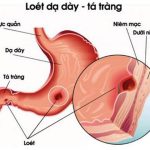 Thực phẩm người bệnh viêm loét dạ dày - tá tràng nên ăn và nên tránh để giảm đau và chữa lành vết loét - Ảnh 2.